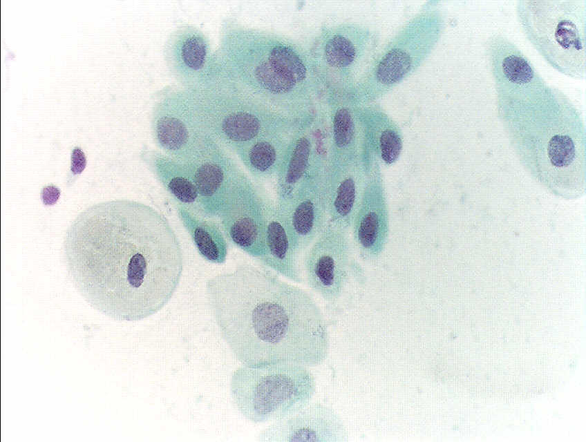 Pap_test_atropy